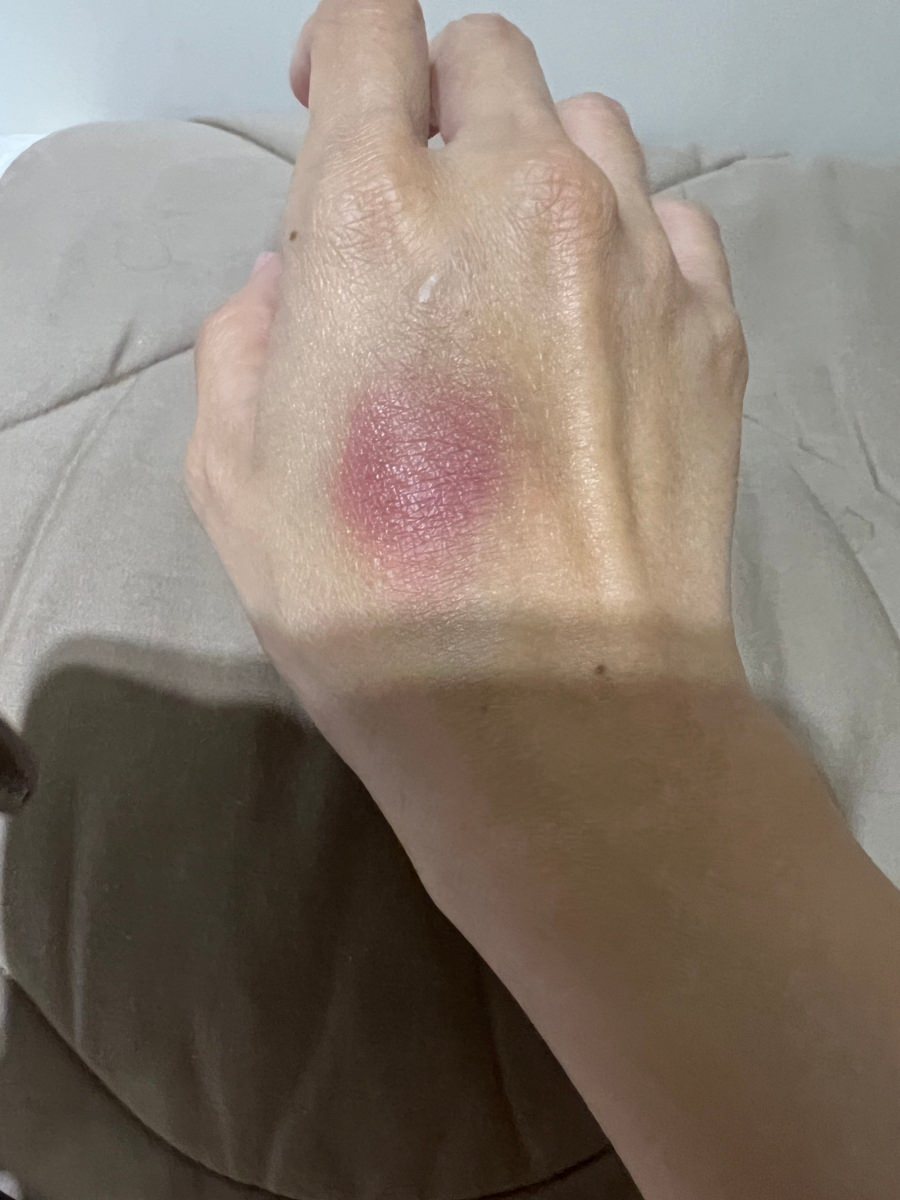 皮膚嚴重大過敏/愛X麗醫美診所 - 第14張圖 皮膚嚴重大過敏/愛X麗醫美診所