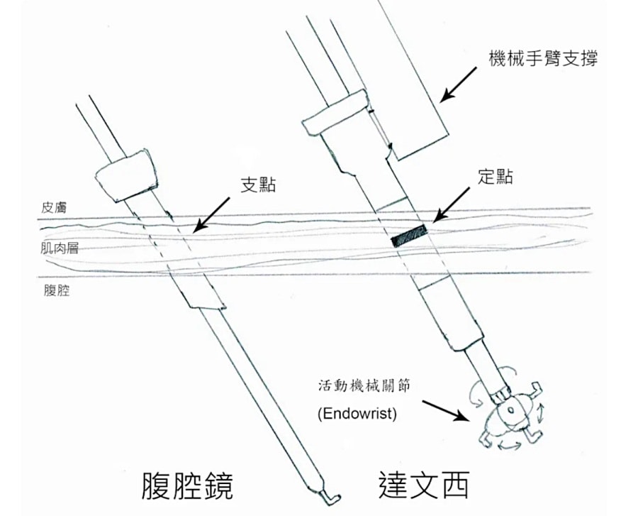 巧克力囊腫抽吸費用/腹腔鏡手術/抽除硬化囊腫/Lantis的奇言妙語 - 第4張圖 巧克力囊腫抽吸費用/腹腔鏡手術/抽除硬化囊腫/Lantis的奇言妙語