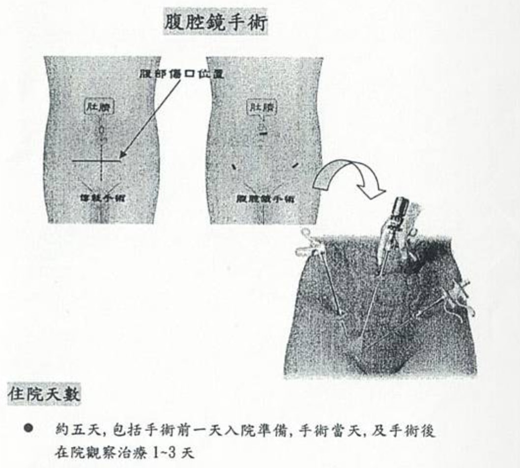 巧克力囊腫抽吸費用/腹腔鏡手術/抽除硬化囊腫/Lantis的奇言妙語 - 第3張圖 巧克力囊腫抽吸費用/腹腔鏡手術/抽除硬化囊腫/Lantis的奇言妙語