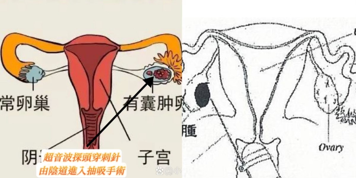 巧克力囊腫抽吸費用/腹腔鏡手術/抽除硬化囊腫/Lantis的奇言妙語 - 第6張圖 巧克力囊腫抽吸費用/腹腔鏡手術/抽除硬化囊腫/Lantis的奇言妙語