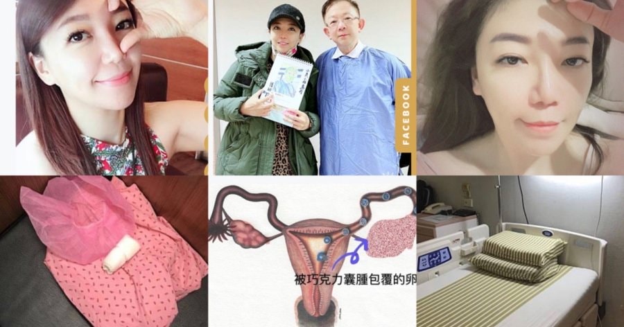 淺談巧克力囊腫抽取tvsae手術(下)什麼!!妳巧克力囊腫又復發了~~ - 第1張圖 淺談巧克力囊腫抽取tvsae手術(下)什麼!!妳巧克力囊腫又復發了~~