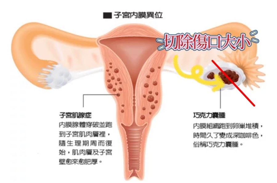 一定要腹腔鏡手術嗎?/巧克力囊腫可以不開刀??!!子宮內膜異位症 - 第6張圖 一定要腹腔鏡手術嗎?/巧克力囊腫可以不開刀??!!子宮內膜異位症