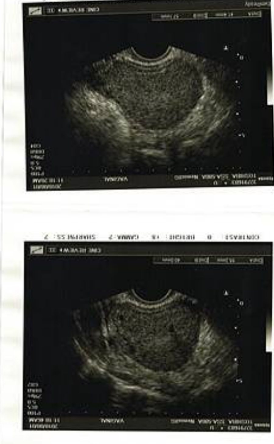 一定要腹腔鏡手術嗎?/巧克力囊腫可以不開刀??!!子宮內膜異位症 - 第8張圖 一定要腹腔鏡手術嗎?/巧克力囊腫可以不開刀??!!子宮內膜異位症