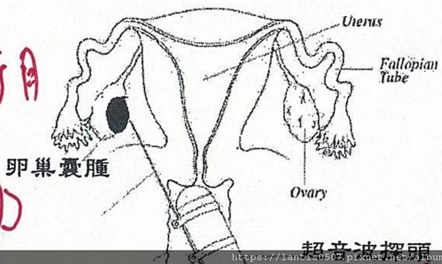 一定要腹腔鏡手術嗎?/巧克力囊腫可以不開刀??!!子宮內膜異位症 - 第11張圖 一定要腹腔鏡手術嗎?/巧克力囊腫可以不開刀??!!子宮內膜異位症