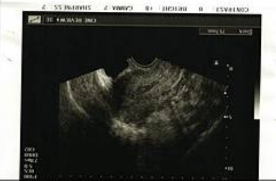 一定要腹腔鏡手術嗎?/巧克力囊腫可以不開刀??!!子宮內膜異位症 - 第10張圖 一定要腹腔鏡手術嗎?/巧克力囊腫可以不開刀??!!子宮內膜異位症
