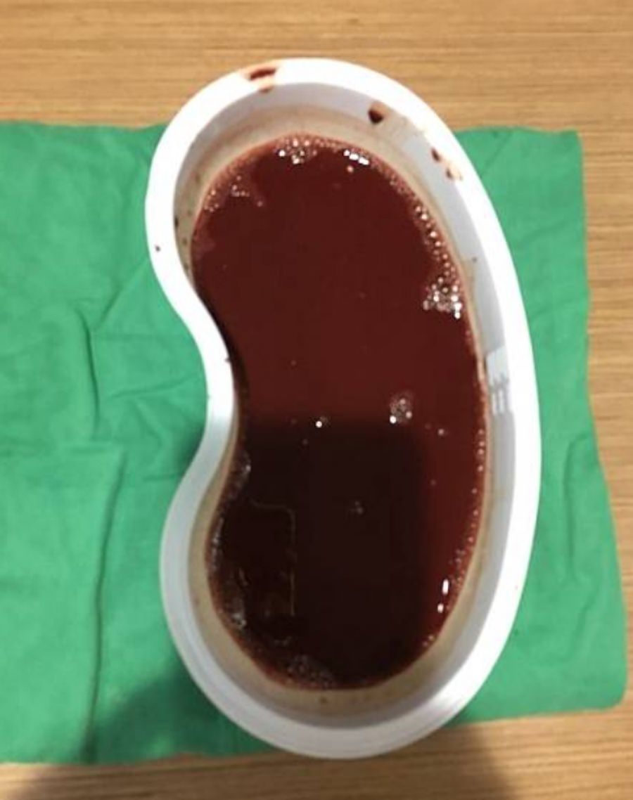 一定要腹腔鏡手術嗎?/巧克力囊腫可以不開刀??!!子宮內膜異位症 - 第12張圖 一定要腹腔鏡手術嗎?/巧克力囊腫可以不開刀??!!子宮內膜異位症