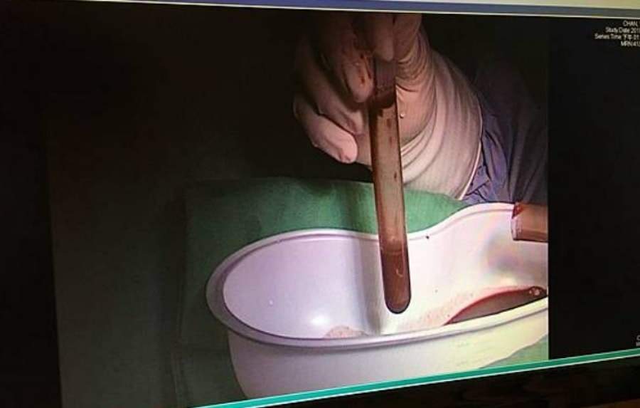 一定要腹腔鏡手術嗎?/巧克力囊腫可以不開刀??!!子宮內膜異位症 - 第13張圖 一定要腹腔鏡手術嗎?/巧克力囊腫可以不開刀??!!子宮內膜異位症