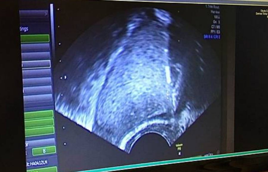 一定要腹腔鏡手術嗎?/巧克力囊腫可以不開刀??!!子宮內膜異位症 - 第15張圖 一定要腹腔鏡手術嗎?/巧克力囊腫可以不開刀??!!子宮內膜異位症