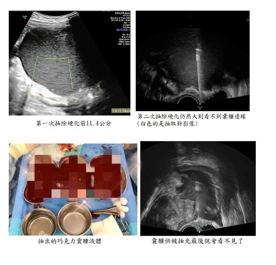 雙側卵巢囊腫別輕言手術/卵巢的重要性/手術有一定的傷害/ - 第1張圖 雙側卵巢囊腫別輕言手術/卵巢的重要性/手術有一定的傷害/