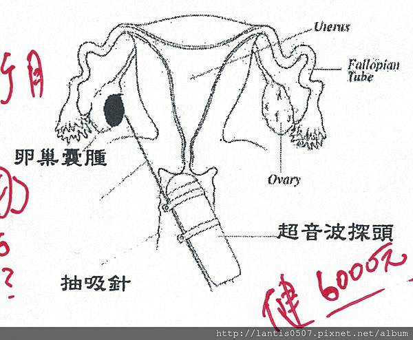 淺談巧克力囊腫抽取tvsae手術(上)什麼!!妳巧克力囊腫又復發了~~