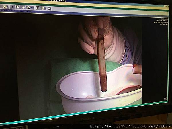 淺談巧克力囊腫抽取tvsae手術!!妳巧克力囊腫又復發了???