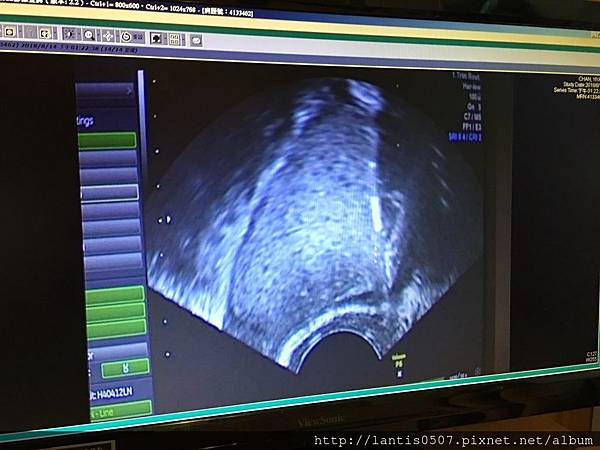 淺談巧克力囊腫抽取tvsae手術!!妳巧克力囊腫又復發了???