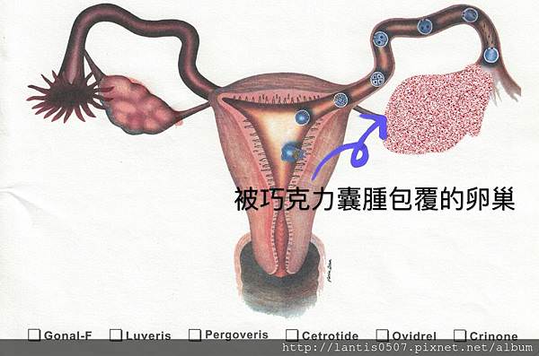 淺談巧克力囊腫抽取硬化手術與腹腔鏡手術/手術差異圖分享