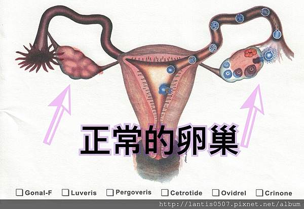 淺談巧克力囊腫抽取硬化手術與腹腔鏡手術/手術差異圖分享
