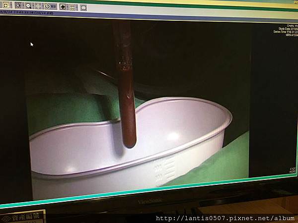 淺談巧克力囊腫抽取tvsae手術!!妳巧克力囊腫又復發了???