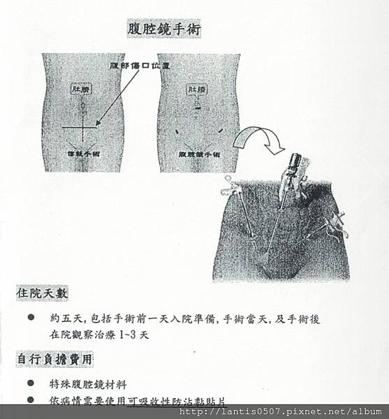 淺談巧克力囊腫抽取tvsae手術(上)什麼!!妳巧克力囊腫又復發了~~
